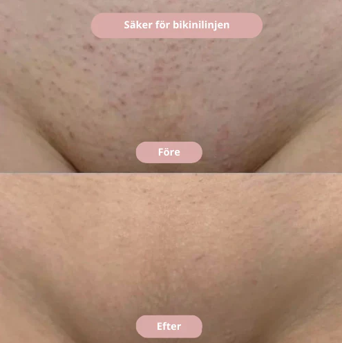SilkLean™ – Rakapparaten för känsliga områden utan irritation